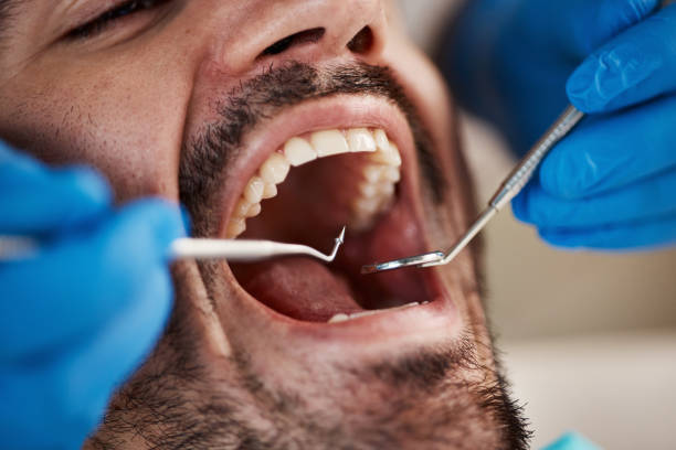 Best Emergency Wisdom Tooth Extraction in Auburndale, FL